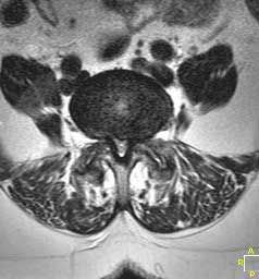 lumbar_stenosis_axial_238_256_80